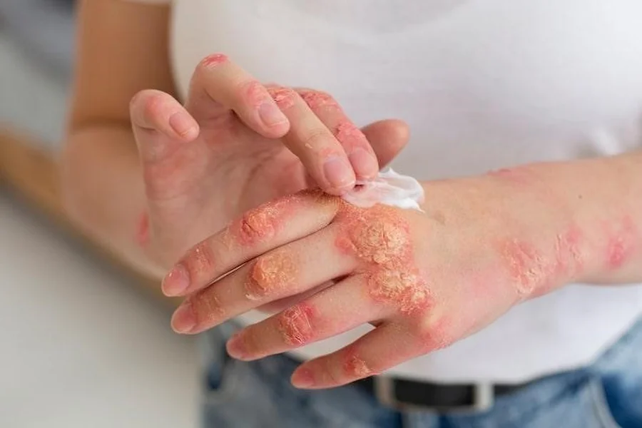 Skin Disorders